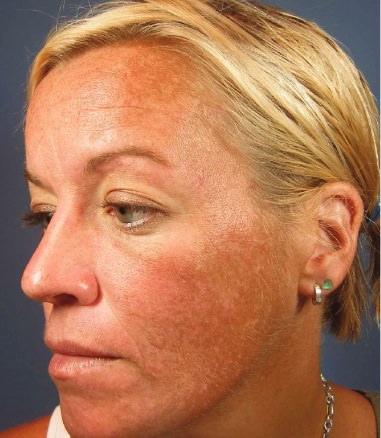 Patient with Rosacea (Before Treatment)